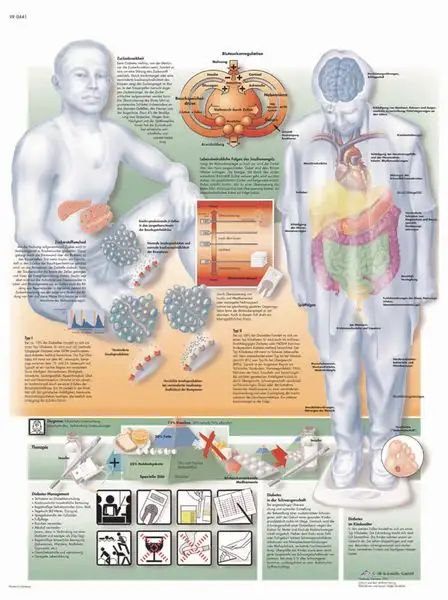 Planche anatomique - Diabète