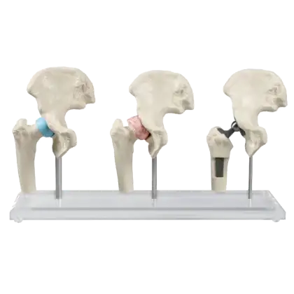 Modèle anatomique du joint de hanche (sain, malade, implant) Erler Zimmer