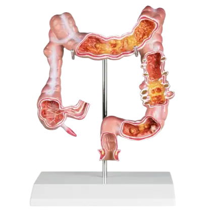 Modèle d'intestin avec maladies Erler Zimmer