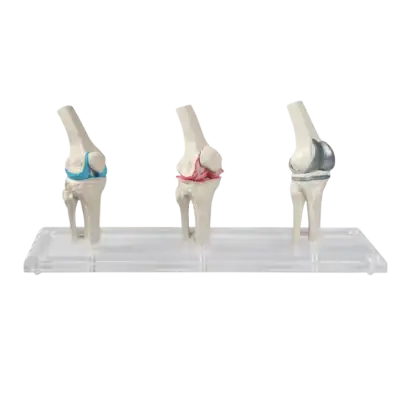 Modèles du genou Erler Zimmer (sain, malade, et avec implant)
