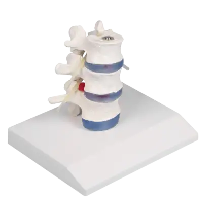 Vertèbres lombaires avec hernie discale Erler Zimmer