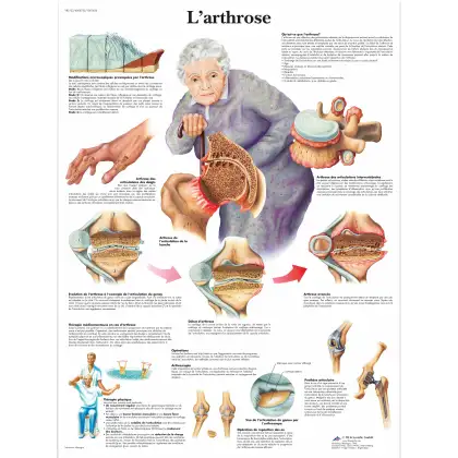 Planche anatomique 3B Scientific - L'arthrose VR2123L