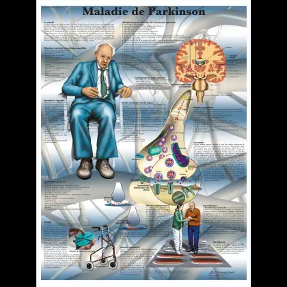 Planche anatomique 3B Scientific - La maladie de Parkinson VR2629